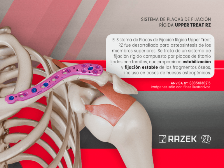 Banner home Mobile Sistema de Placas de Fixação Rígida Upper Treat RZ - ES